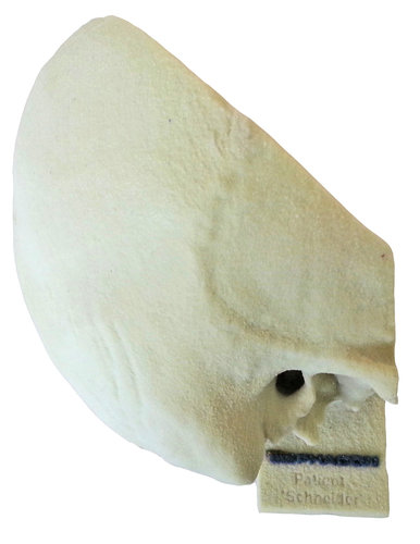 PHACON Temporal Bone